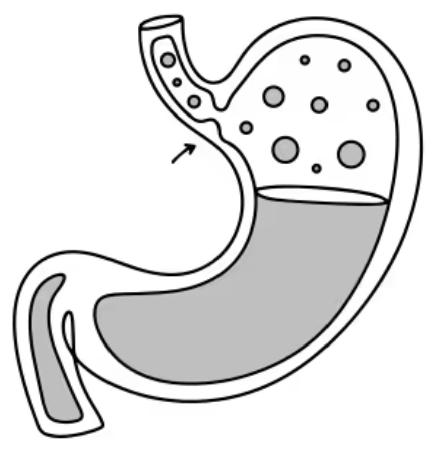 Laryngopharyngeal Reflux